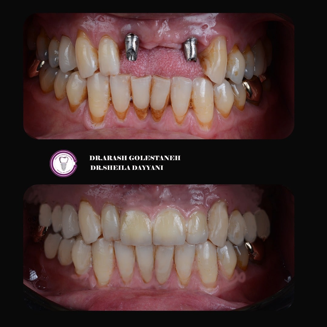 نمونه کار ایمپلنت دندان در اصفهان توسط دکتر گلستانه