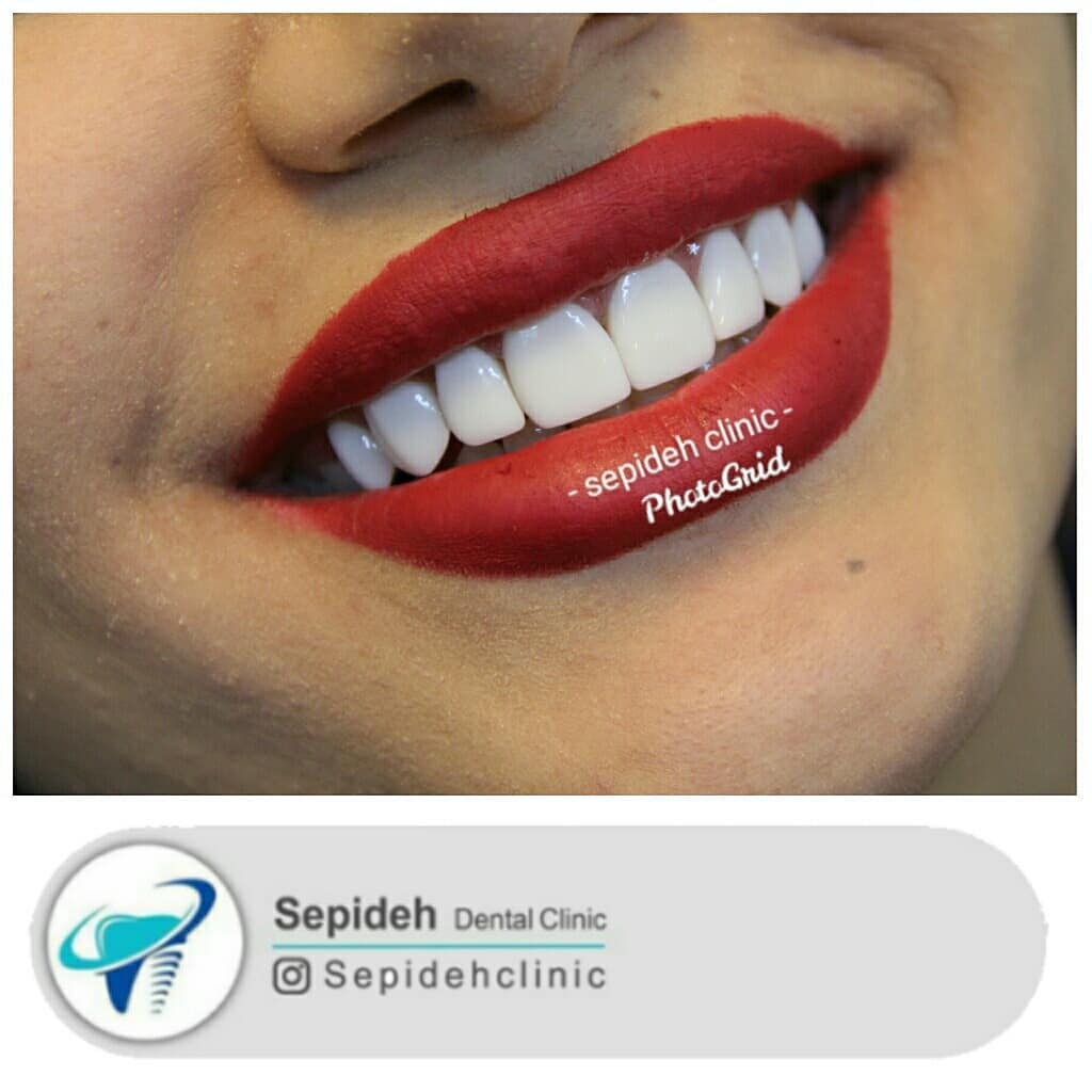 نمونه کار زیبایی دندان| کلینیک دندانپزشکی سپیده شیراز