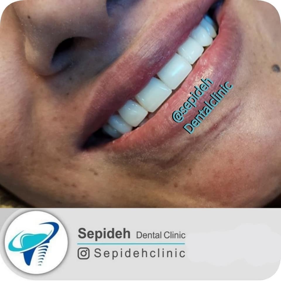 نمونه کار زیبایی دندان| کلینیک دندانپزشکی سپیده شیراز