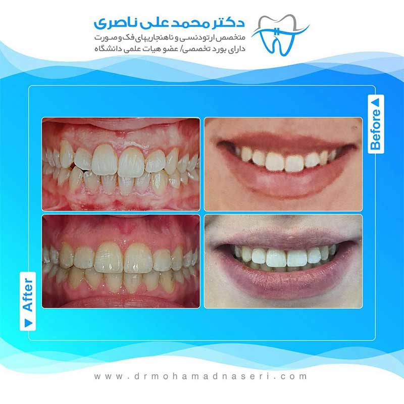 نمونه کار ارتودنسی دندان قبل و بعد توسط دکتر محمدعلی ناصری