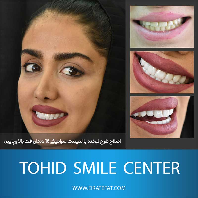 نمونه کار ترمیم زیبایی دندان توسط دکتر محمد عاطفت
