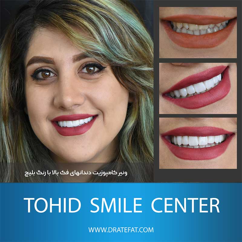 نمونه کار ترمیم زیبایی دندان توسط دکتر محمد عاطفت