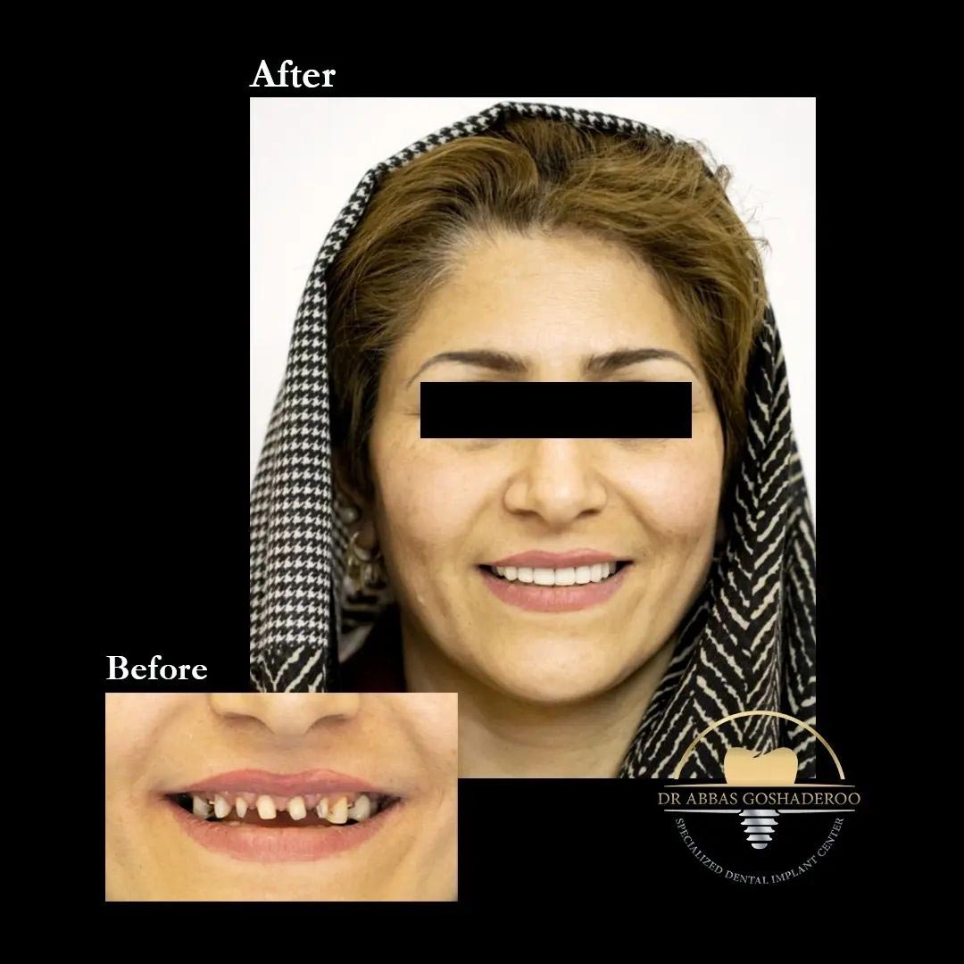 جراحی و کاشت ایمپلنت دندان|دکتر عباس گشاده رو متخصص ایمپلنت