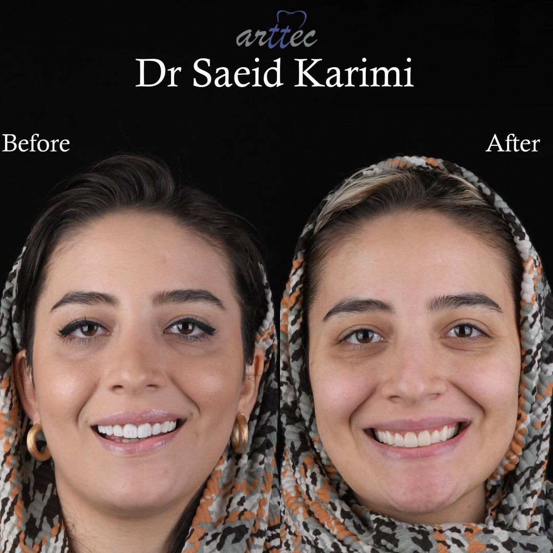 لمینت دندان دکتر سعید کریمی دندانپزشک زیبایی