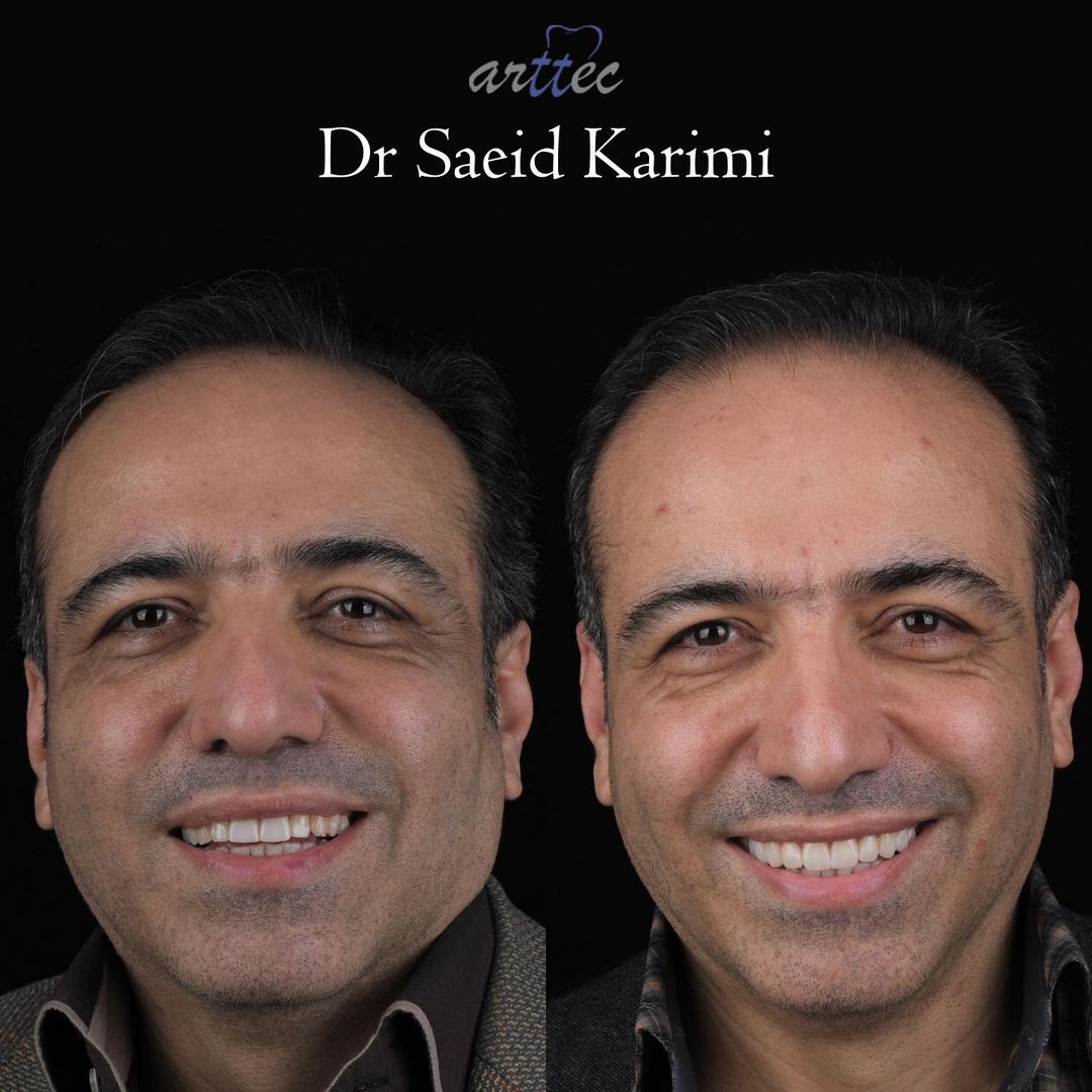 اصلاح طرح لبخند دکتر سعید کریمی دندانپزشک زیبایی