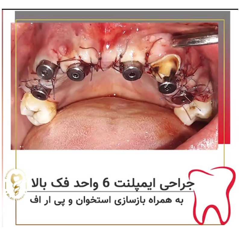 نمونه کار ایمپلنت دندان توسط دکتر علی قمری متخصص ایمپلنت
