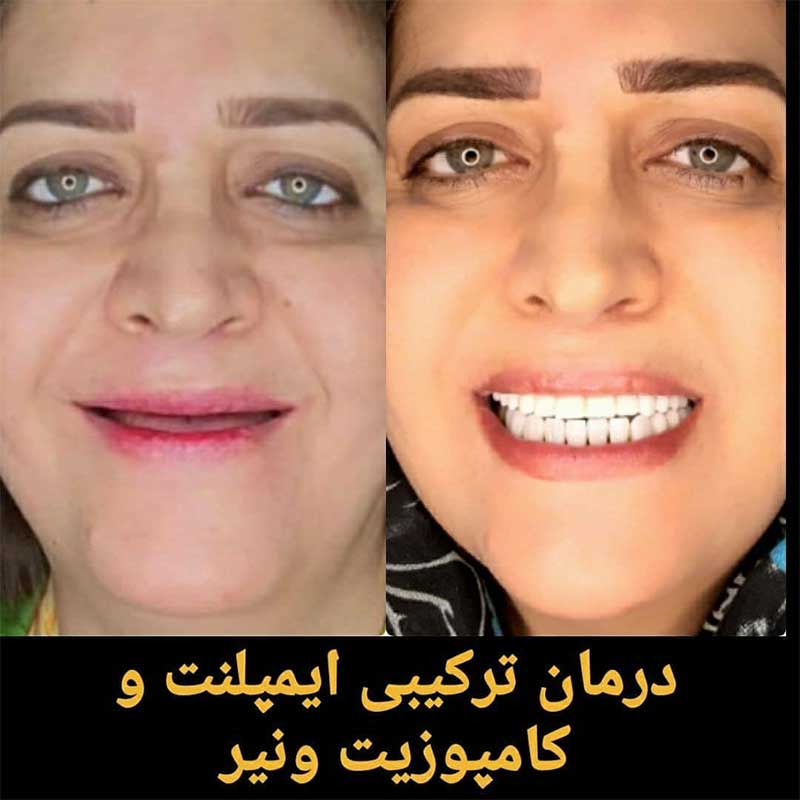 ایمپلنت دندان دکتر سید مهدی حسینیان متخصص ایمپلنت در تهران