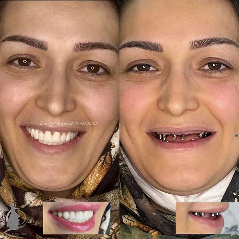 ایمپلنت دندان دکتر سید مهدی حسینیان متخصص ایمپلنت در تهران