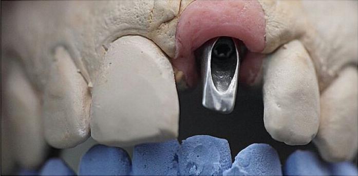 ایمپلنت - سینی باز| دندانسازی پارس تکنیک شیراز