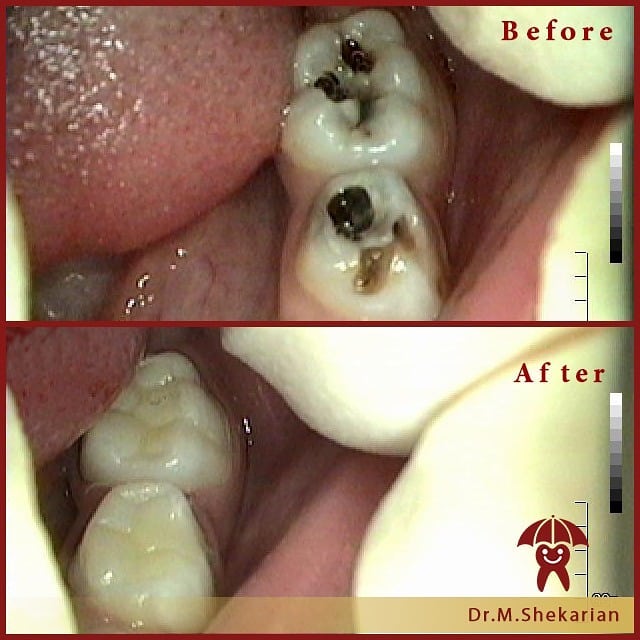عصب کشی دندان کودک | دکتر ماریتا شکاریان