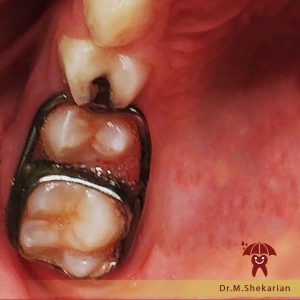 ارتودنسی دندان کودکان | دکتر ماریتا شکاریان