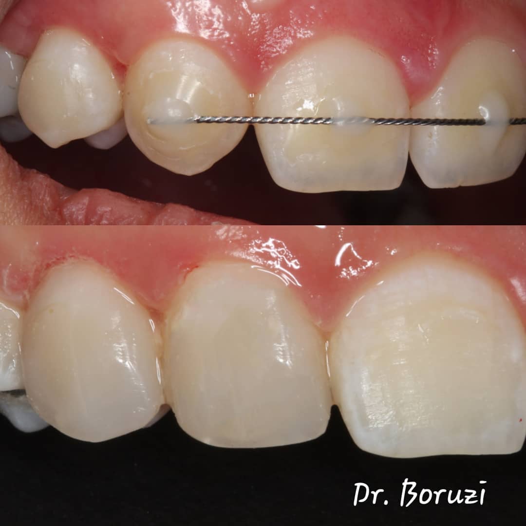 طراحی لبخند | دکتر علیرضا بروزی نیت دندانپزشک زیبایی مشهد
