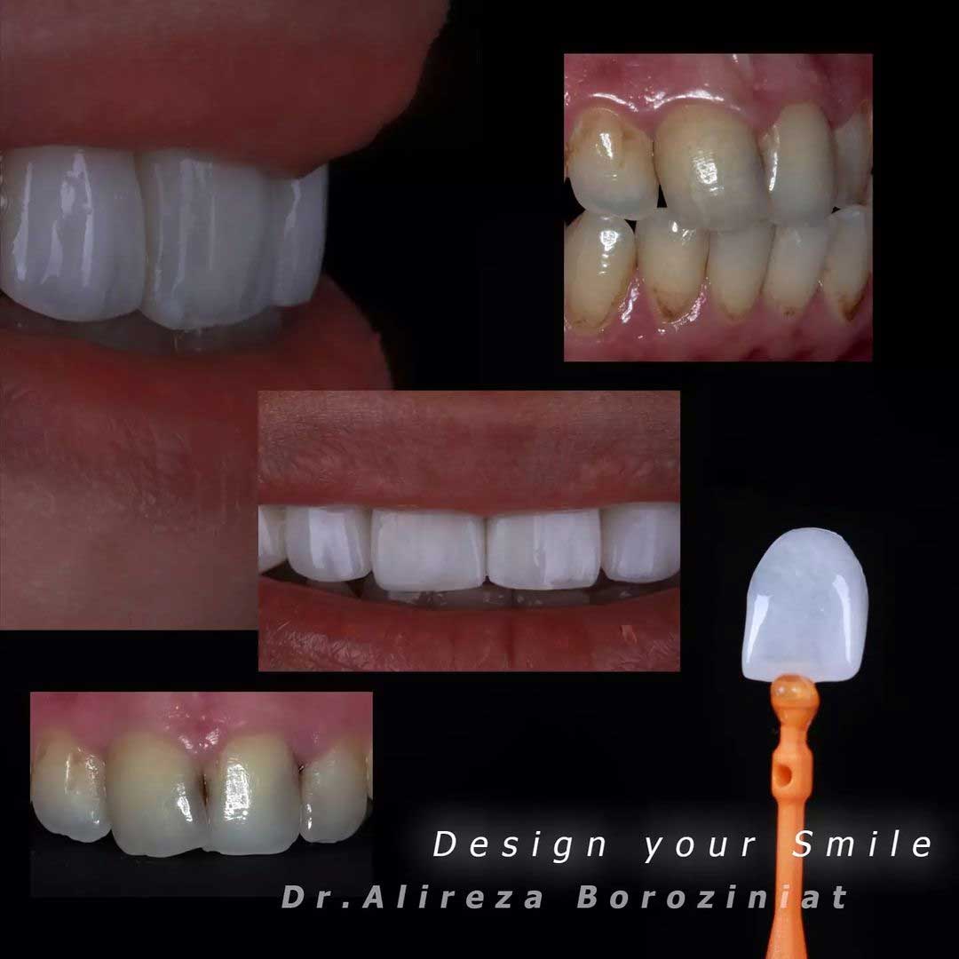طراحی لبخند | دکتر علیرضا بروزی نیت دندانپزشک زیبایی مشهد