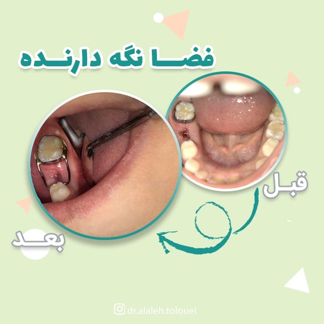 نمونه کار دکتر آلاله طلوعی | متخصص دندانپزشکی کودکان