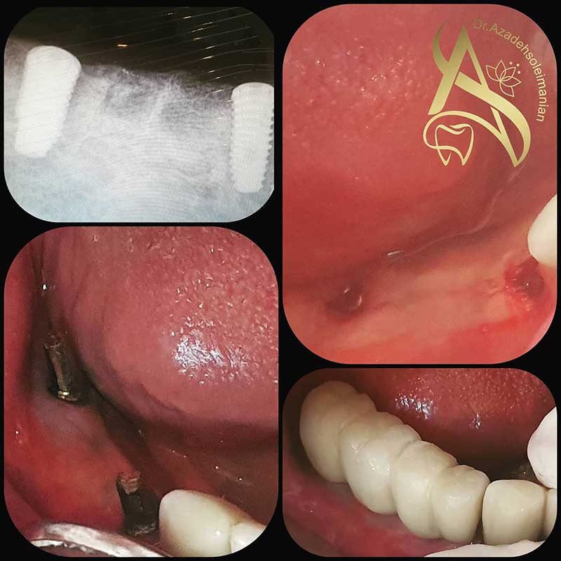 نمونه کاشت دندان توسط دکتر آزاده سلیمنیان متخصص کاشت دندان در یزد