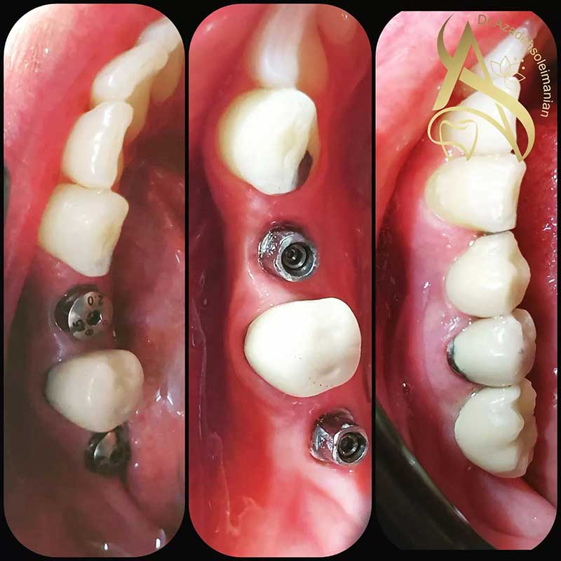 نمونه کاشت دندان توسط دکتر آزاده سلیمنیان متخصص کاشت دندان در یزد