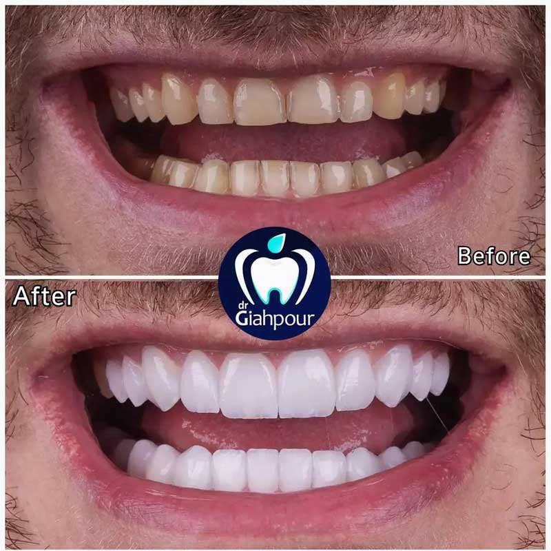 نمونه کار دندانپزشکی زیبایی | کلینیک دنتال ایرانیان تهران