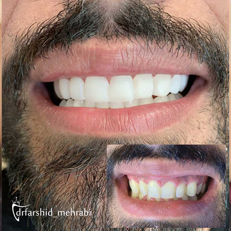 نمونه کار طراحی لبخند | دکتر فرشید محرابی دندانپزشک زیبایی
