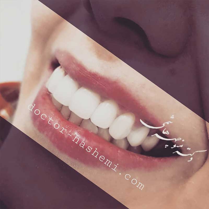 لمینت دندان | دکتر سید منوچهر هاشمی دندانپزشک زیبایی
