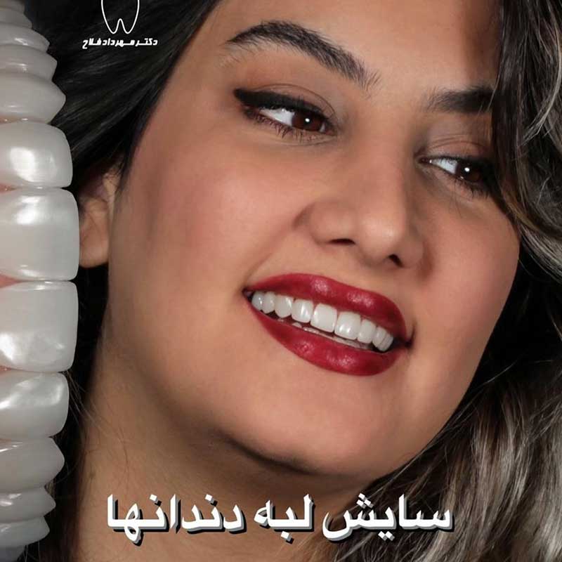 نمونه کار ونیر کامپوزیت دکتر مهرداد فلاح | متخصص دندانپزشک زیبایی تهران
