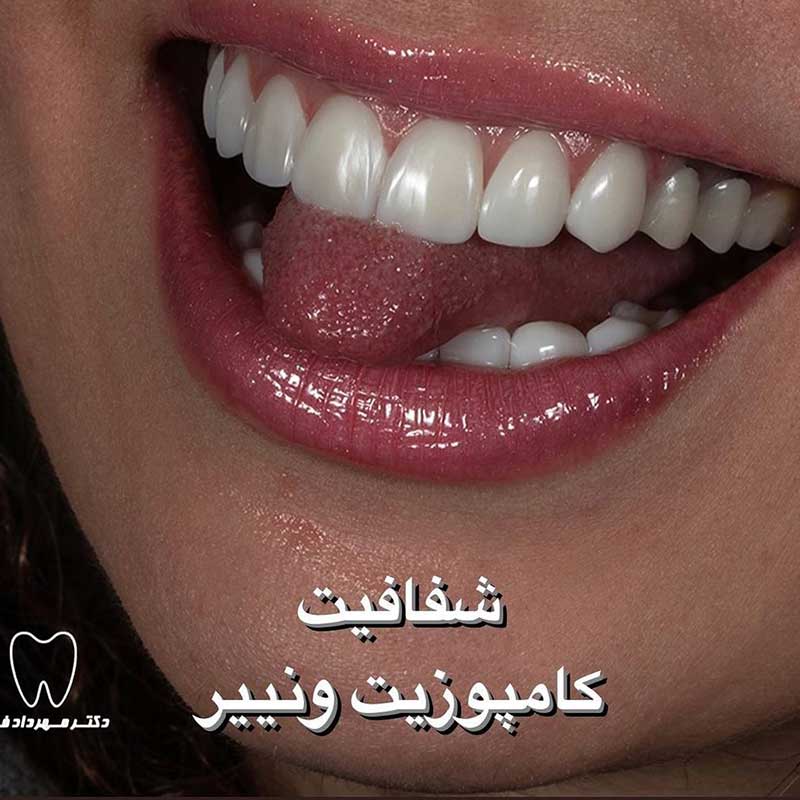 نمونه کار ونیر کامپوزیت دکتر مهرداد فلاح | متخصص دندانپزشک زیبایی تهران