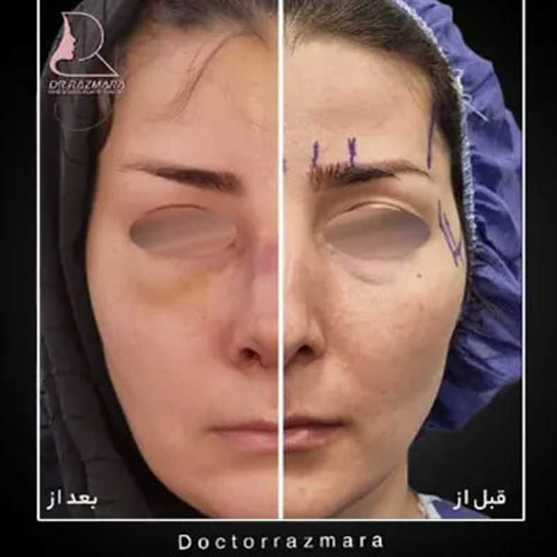 نمونه کار دکتر نرگس رزم آرا جراح بینی و جراح پلاستیک در مشهد