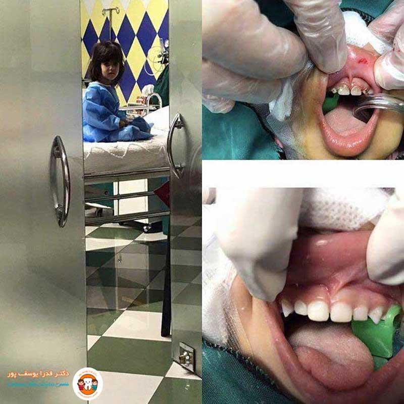 نمونه کار دکتر فدرا یوسف پور متخصص دندانپزشکی کودکان کرج