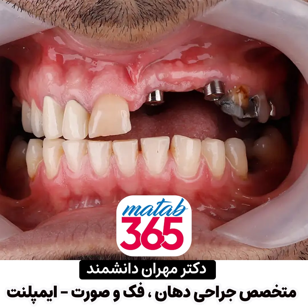 نمونه کار دکتر مهران دانشمند متخصص جراحی دهان، فک و صورت و ایمپلنت