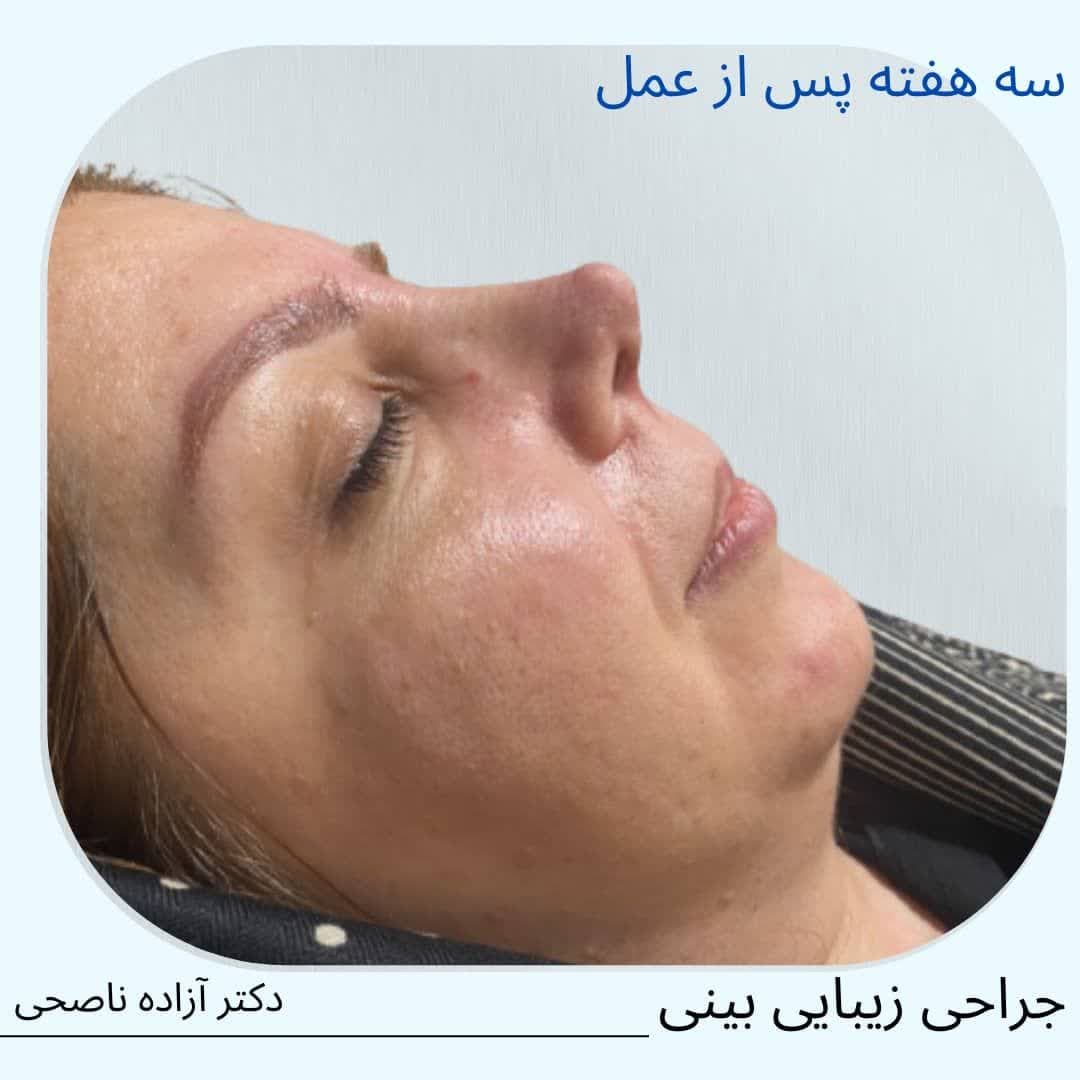 نمونه کار جراحی بینی دکتر آزاده ناصحی متخصص جراح بینی در تهران