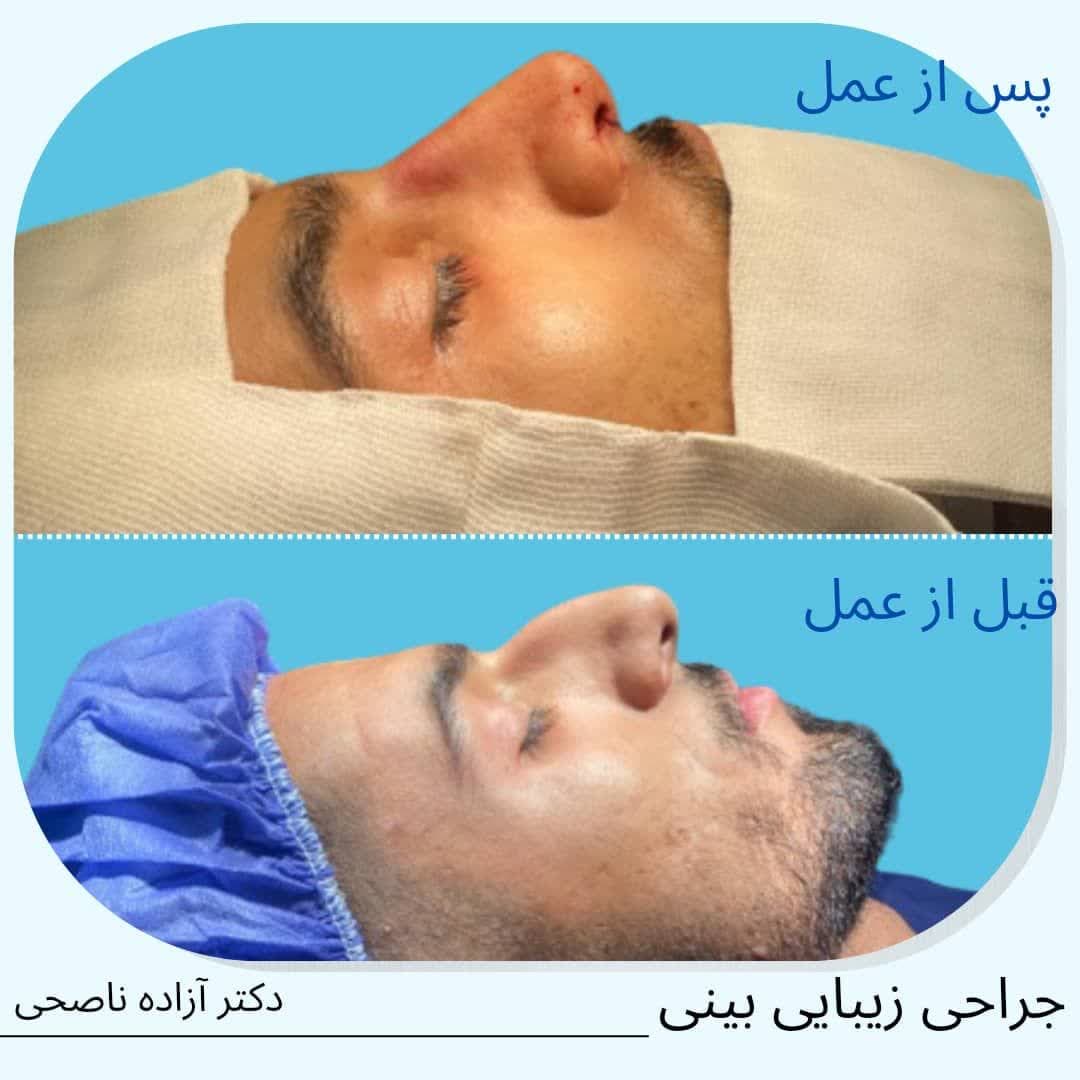 نمونه کار جراحی بینی دکتر آزاده ناصحی متخصص جراح بینی در تهران