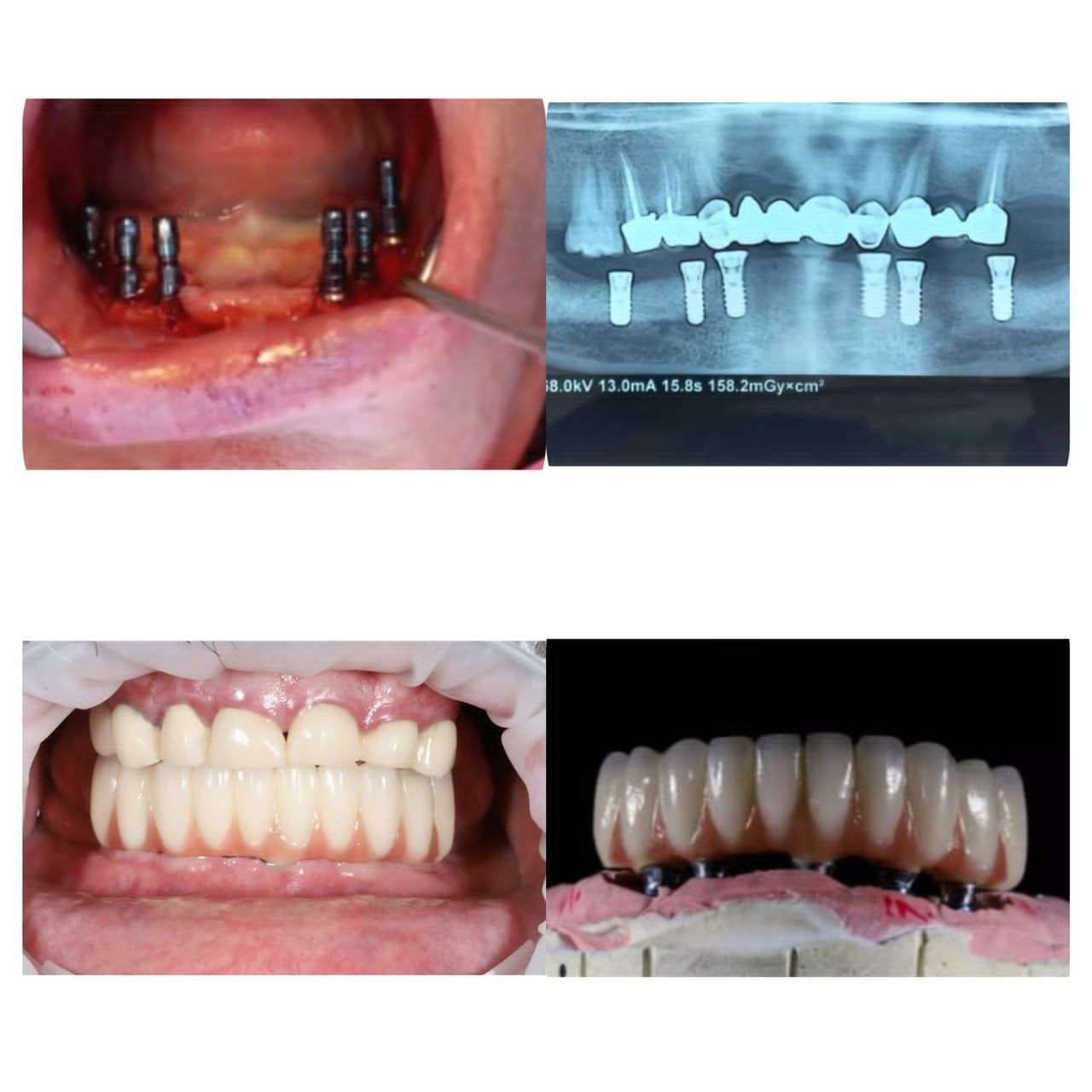 نمونه کار ایمپلنت دندان | دکتر مهران دانشمند متخصص ایمپلنت در شهرکرد