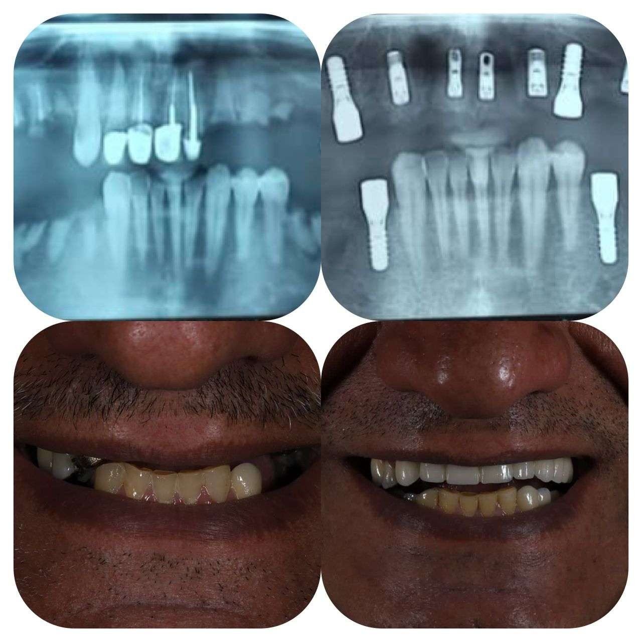 نمونه کار ایمپلنت دندان | دکتر مهران دانشمند متخصص ایمپلنت در شهرکرد