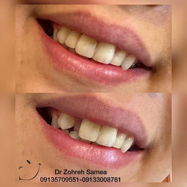 نمونه کار زیبایی دکتر زهره سامع دندانپزشک زیبایی در اصفهان