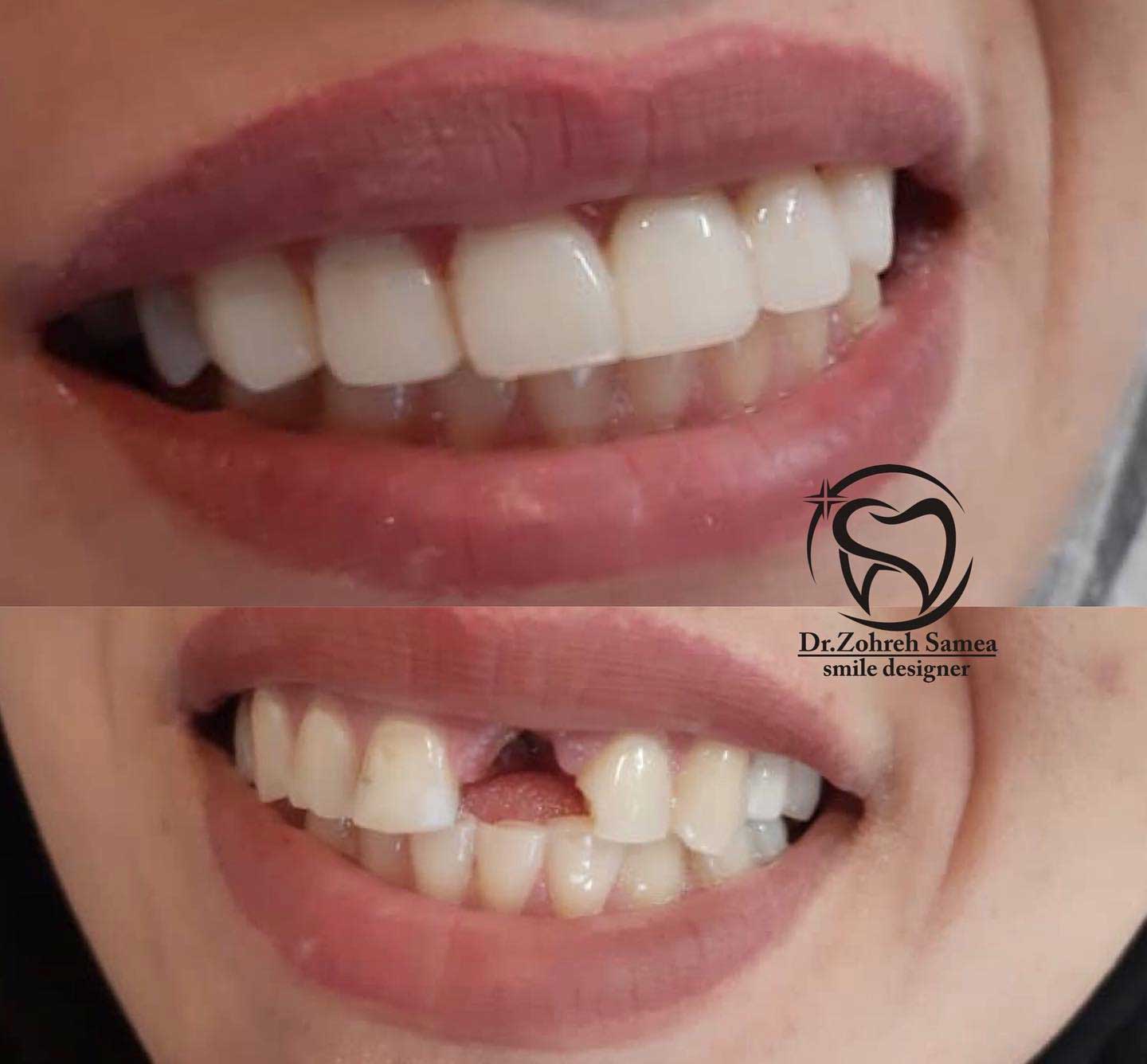 نمونه کار زیبایی دکتر زهره سامع دندانپزشک زیبایی در اصفهان