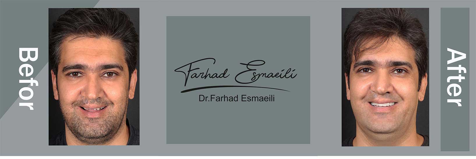 نمونه کار ایمپلنت دیجیتال در اصفهان توسط دکتر فرهاد اسماعیلی