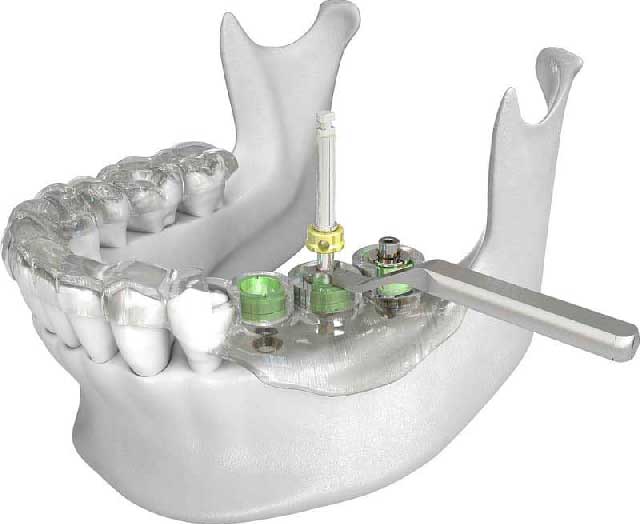 کاشت دندان به روش دیجیتال