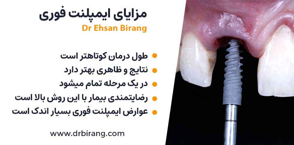 مزایای ایمپلنت فوری نسبت به کاشت دندان سنتی