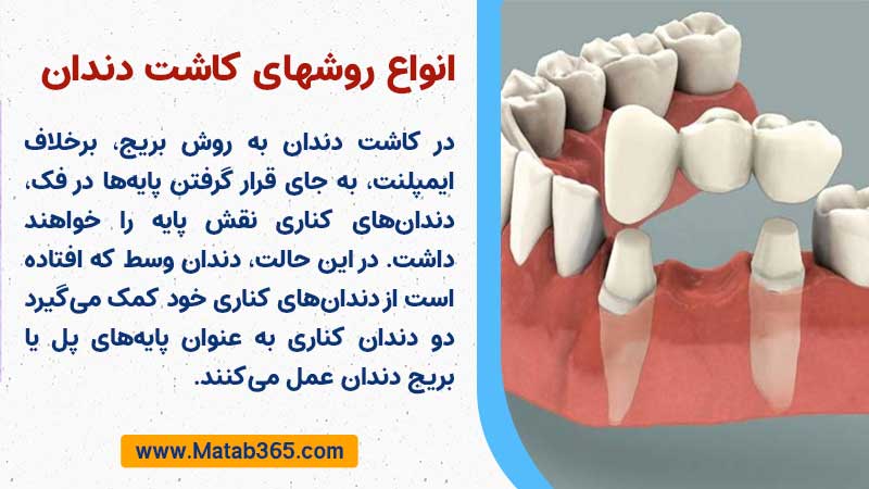 انواع روشهای کاشت دندان در تهران