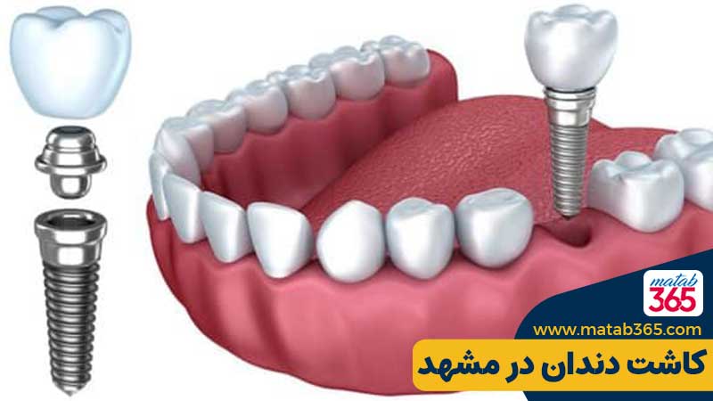 کاشت دندان در مشهد توسط متخصص ایمپلنت مشهد