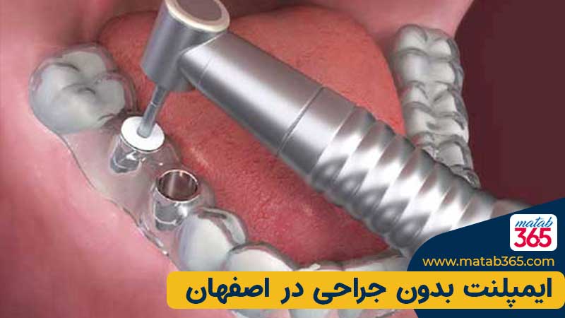 ایمپلنت بدون جراحی در اصفهان