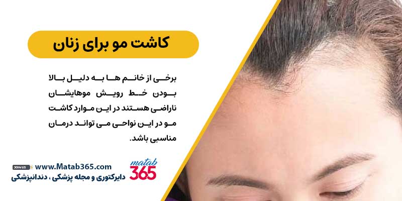 کاشت مو در اصفهان برای زنان