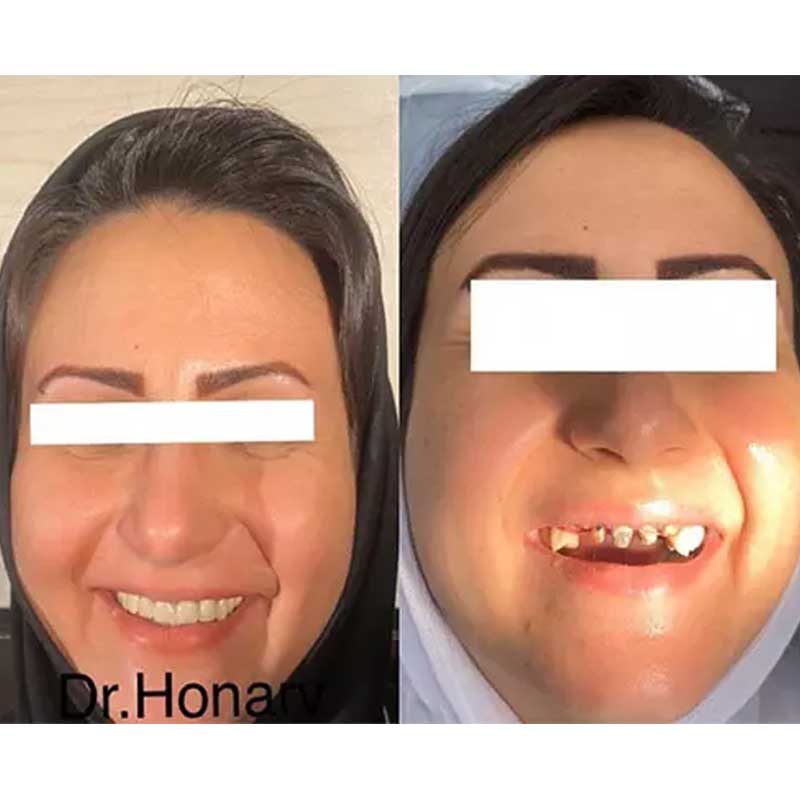 نمونه کار ایمپلنت دندان در شیراز | دکتر معین هنرور