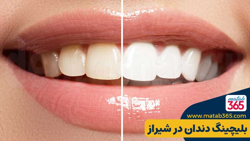 بلیچینگ دندان شیراز