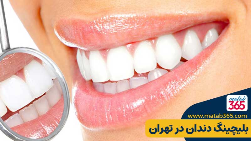 بلیچینگ دندان در تهران