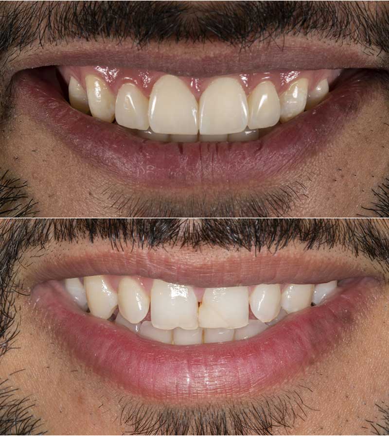 ونیر کامپوزیت انجام شده توسط دکنر ابطحی متخصص دندانپزشکی زیبایی