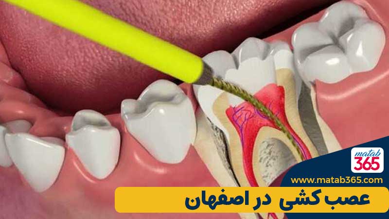 عصب کشی دندان در اصفهان