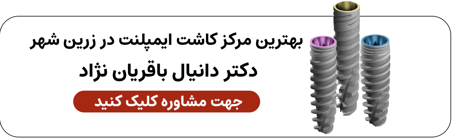 کاشت ایمپلنت در زرین شهر اصفهان