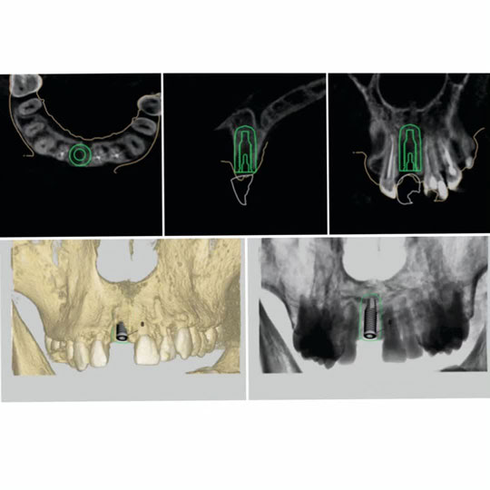 کاشت ایمپلنت دندان در ناحیه قدامی با استفاده از ایمپلنت دیجیتال