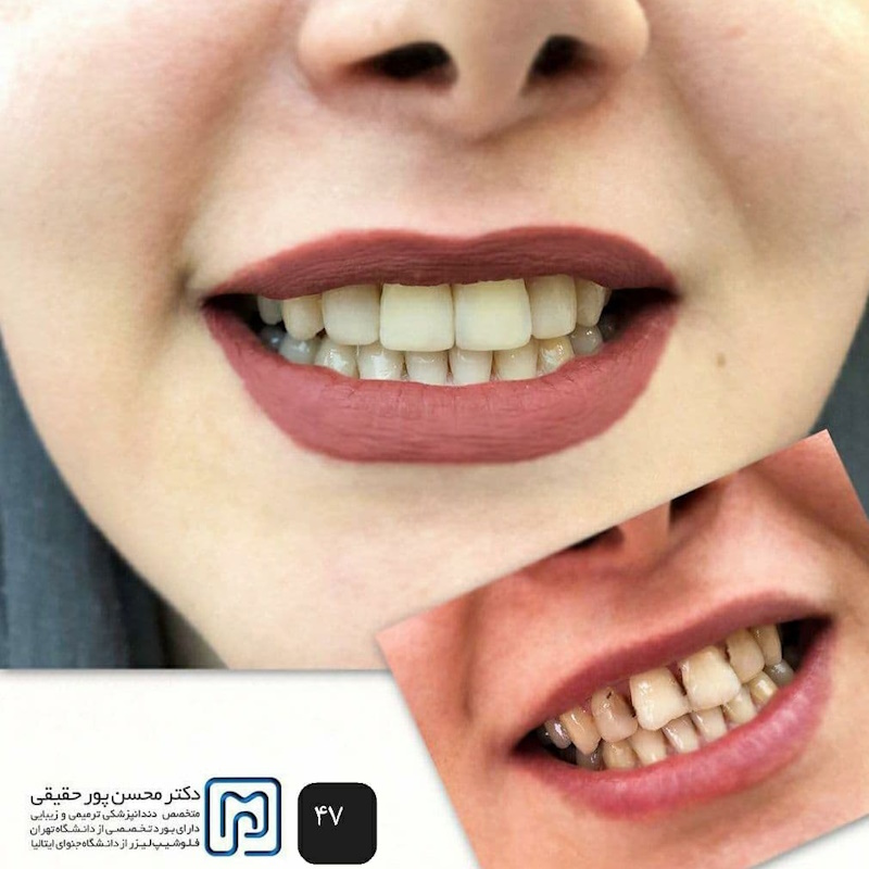 نمونه کار دکتر محسن پور حقیقی | فلوشیپ دندانپزشکی زیبایی و ترمیمی در تهران