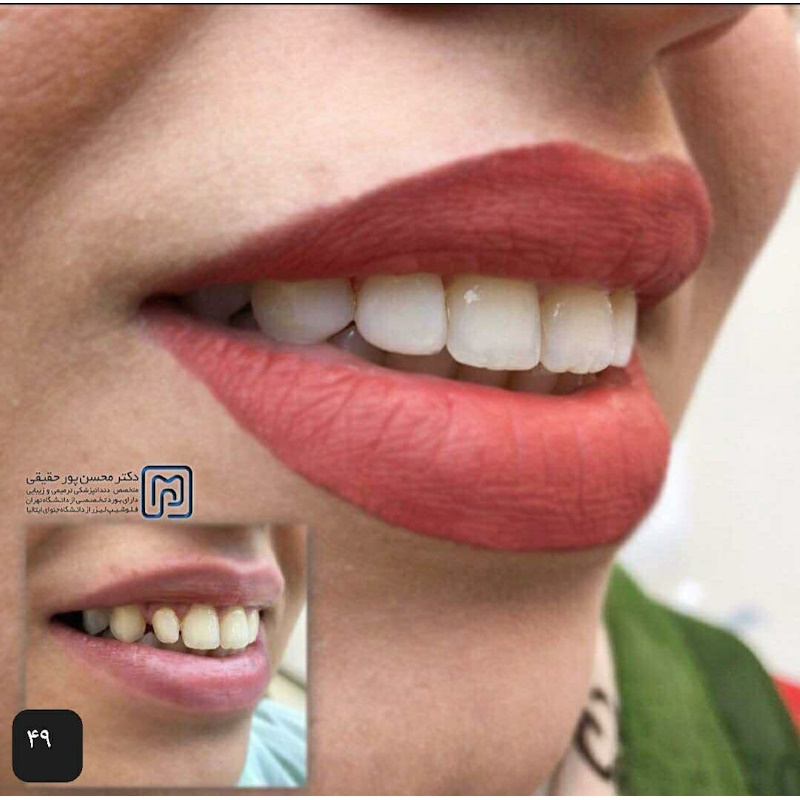 نمونه کار دکتر محسن پور حقیقی | فلوشیپ دندانپزشکی زیبایی و ترمیمی در تهران